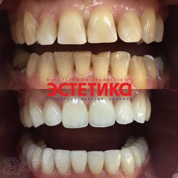 Мечтаете о белоснежной улыбке? Стоматология «Эстетика» поможет Вам!