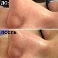 Ультразвуковая чистка лица