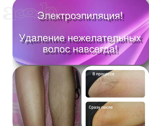Электроэпиляция