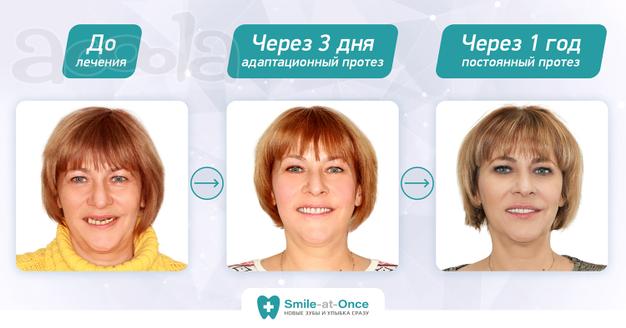 Полный зубной протез за один день
